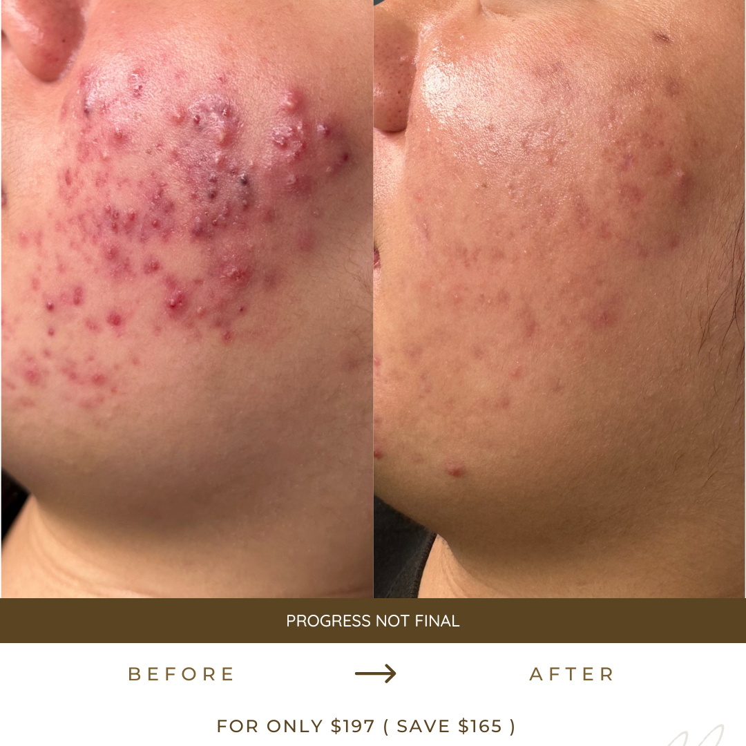 Before and after comparison of skin treatment on a person's acne with promotional text at the bottom.