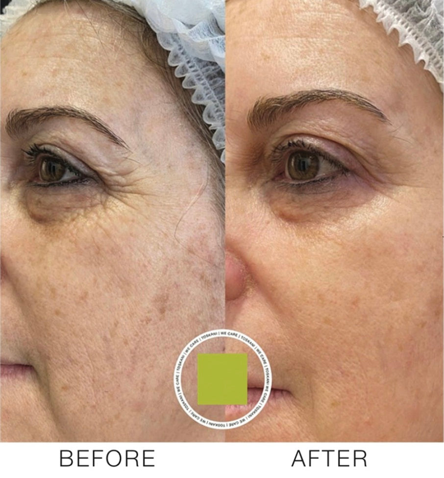 Salmon DNA (PDRN) Microneedling Transformation Series (3 Sessions)