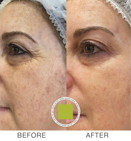 Salmon DNA (PDRN) Microneedling Transformation Series (3 Sessions)