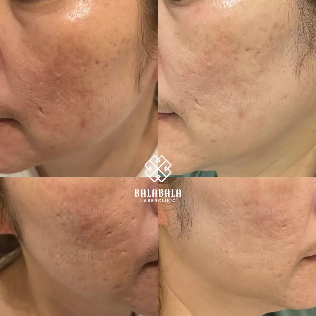 Salmon DNA (PDRN) Microneedling Transformation Series (3 Sessions)