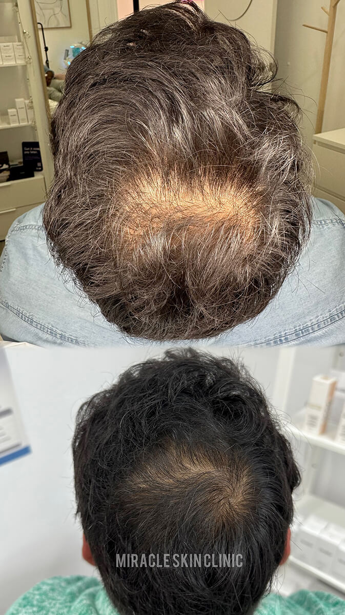 Black Friday Exclusive – Hair Growth & Scalp Regeneration Series (3 Sessions)