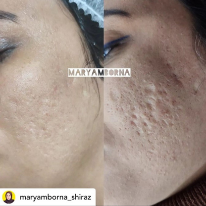 Salmon DNA (PDRN) Microneedling Transformation Series (3 Sessions)